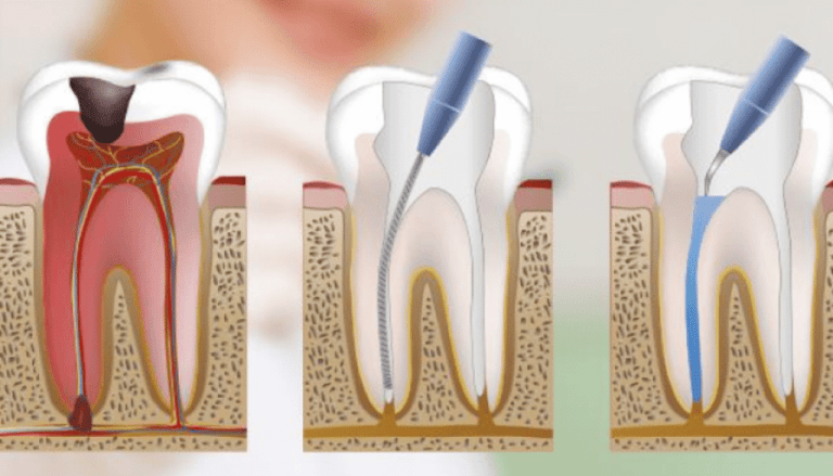 endodonzia a San Lazzaro di Savena