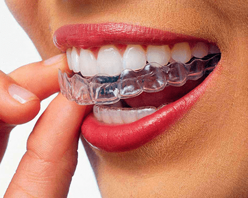 foto invisalign